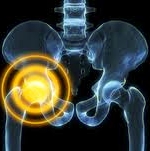 Stryker LFIT V40 Hip Implant Injuries Linked to Mixed Metals
