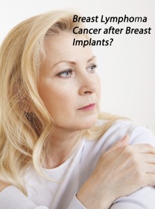 Breast Lymphoma Cancer after Breast Implant attorney